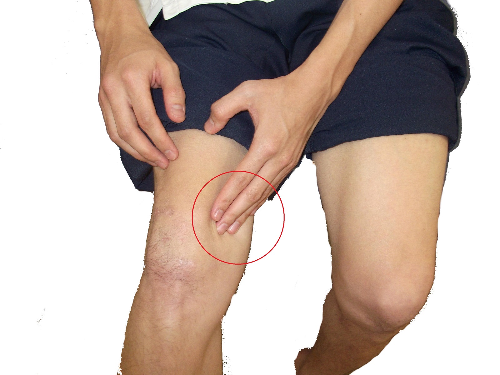 膝 曲げる と 激痛
